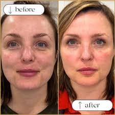 treatment for wrinkles